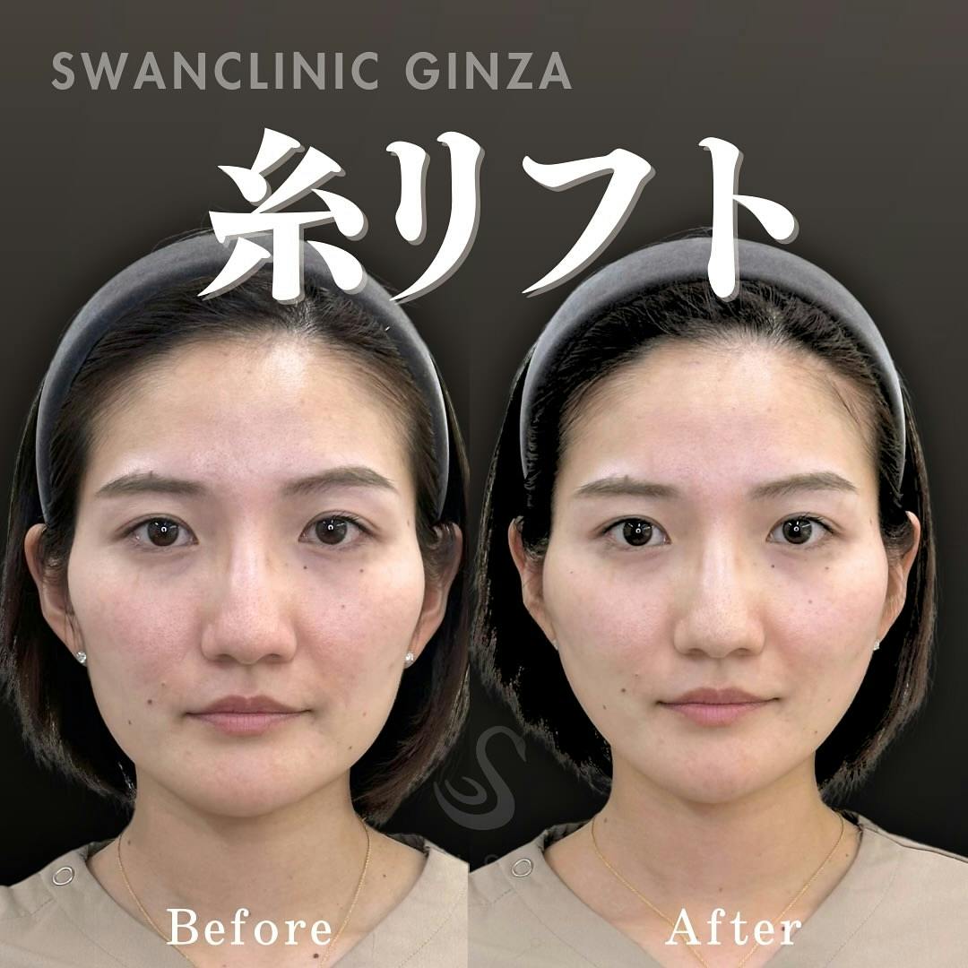 【女性・輪郭】糸リフト ヒアルロン酸注入 エラボトックス_before_aftar