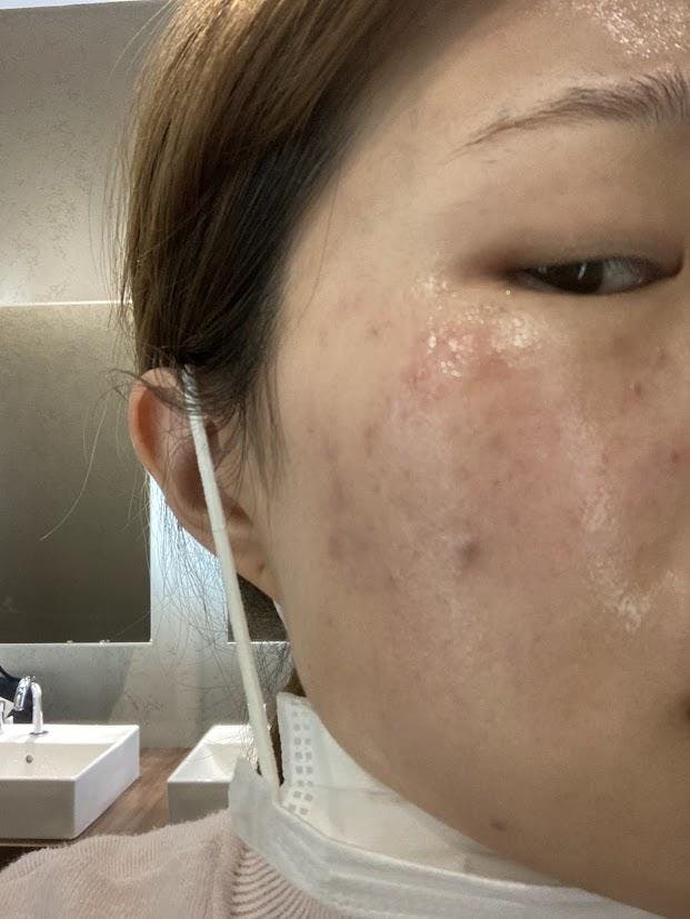 よつば会クリニック 大阪梅田院で美顔+シミ取りコース:美顔+シミ取りコースを受けたさなさんの写真