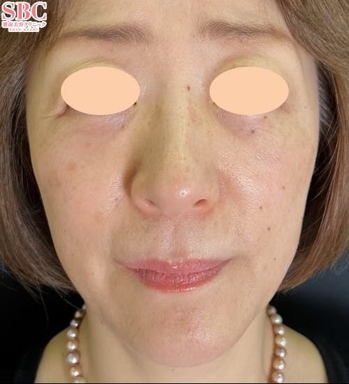 【50代女性・たるみ】目の下の切らないクマ・たるみ（ふくらみ）取り ナチュラル脂肪注射コンデンスリッチ_after