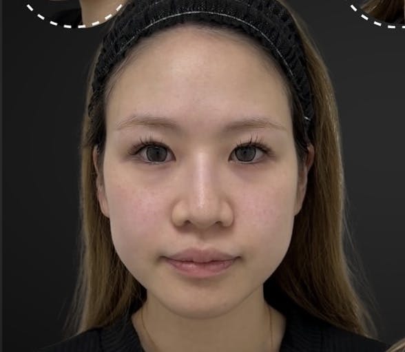 【20代女性・フェイスライン】糸リフト_b1