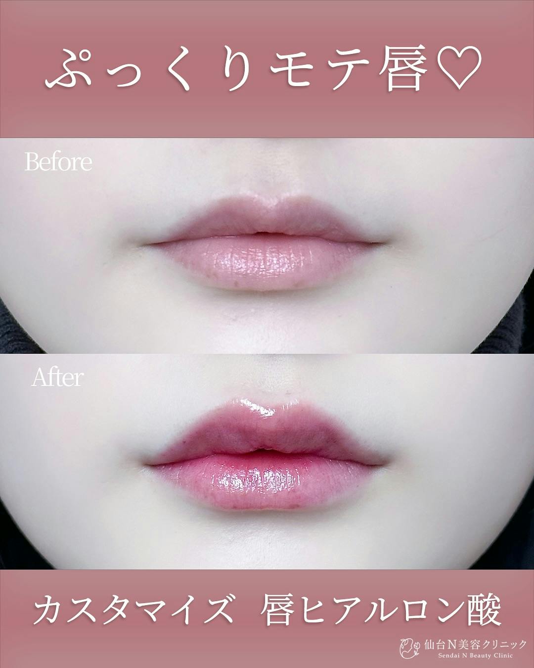 【女性・唇】ヒアルロン酸 ボルベラ_before_aftar