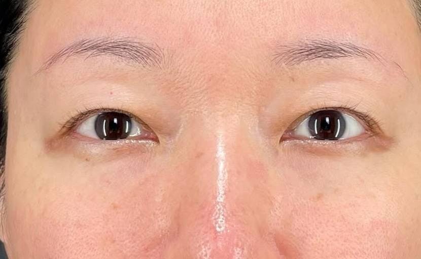 セオリークリニック(Theoryクリニック)で眉下切開：眉下切開を受けたお祭り大好き～にょさんの写真