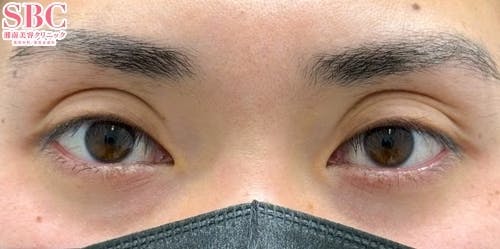 【目元】眼瞼下垂 タルミ取り併用全切開法二重_before