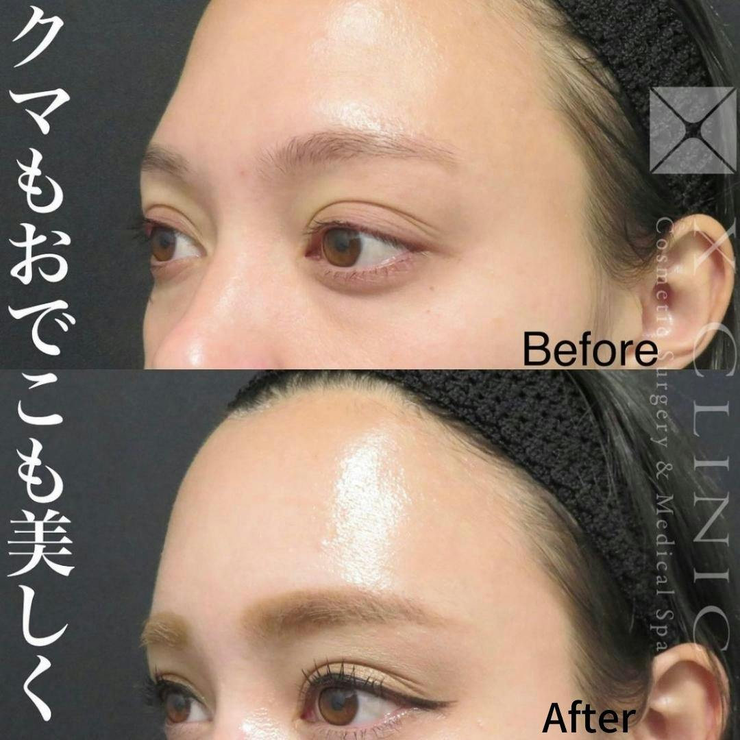 【女性・目元】クマフル＋額こめかみ脂肪注入_before_aftar