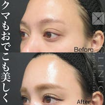 【女性・目元】クマフル+額こめかみ脂肪注入_before_aftar