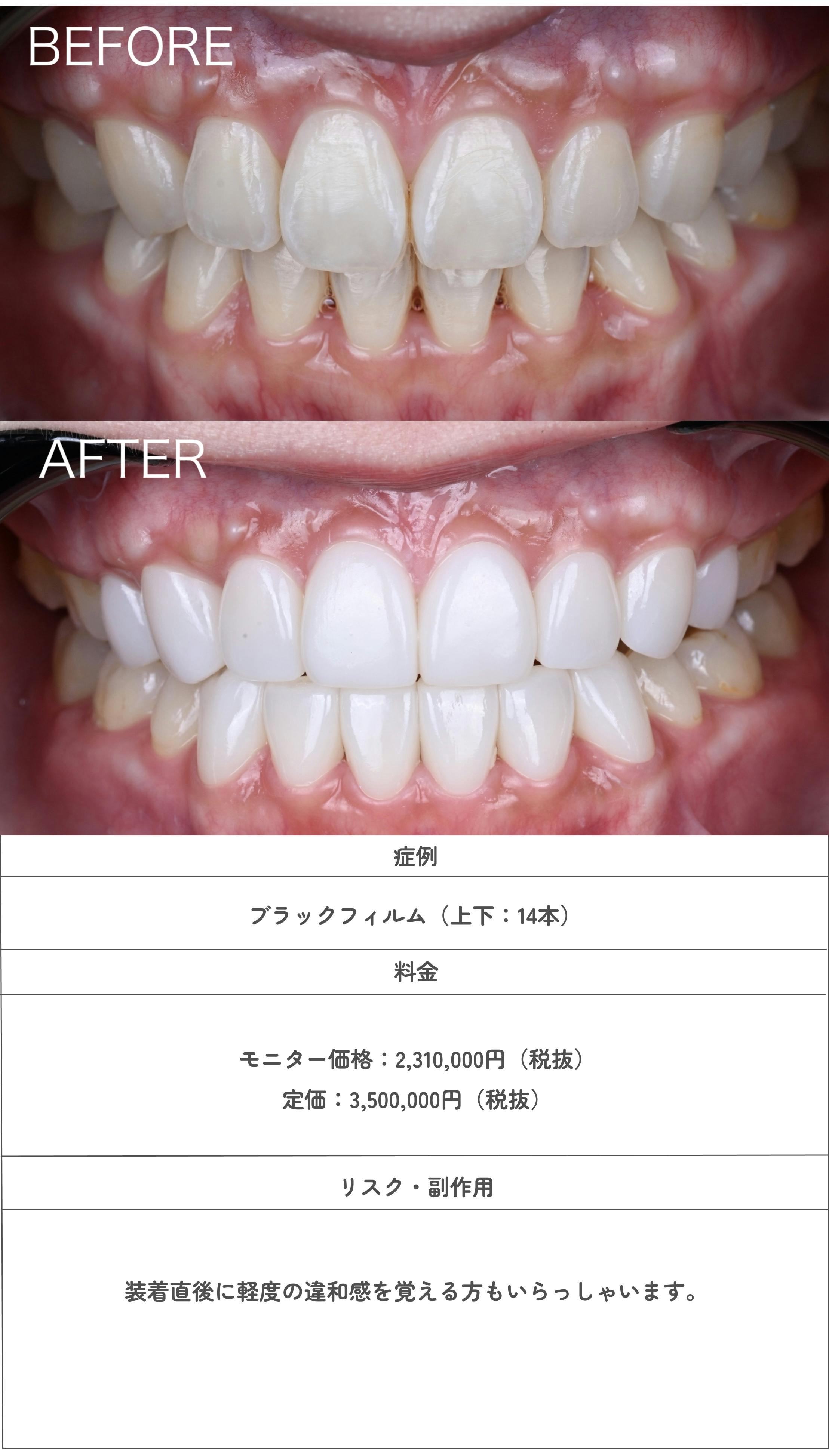ブラックフィルムの症例写真