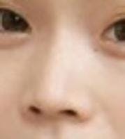 城本クリニック福岡院で鼻ヒアルロン酸を受けたりりさんの写真