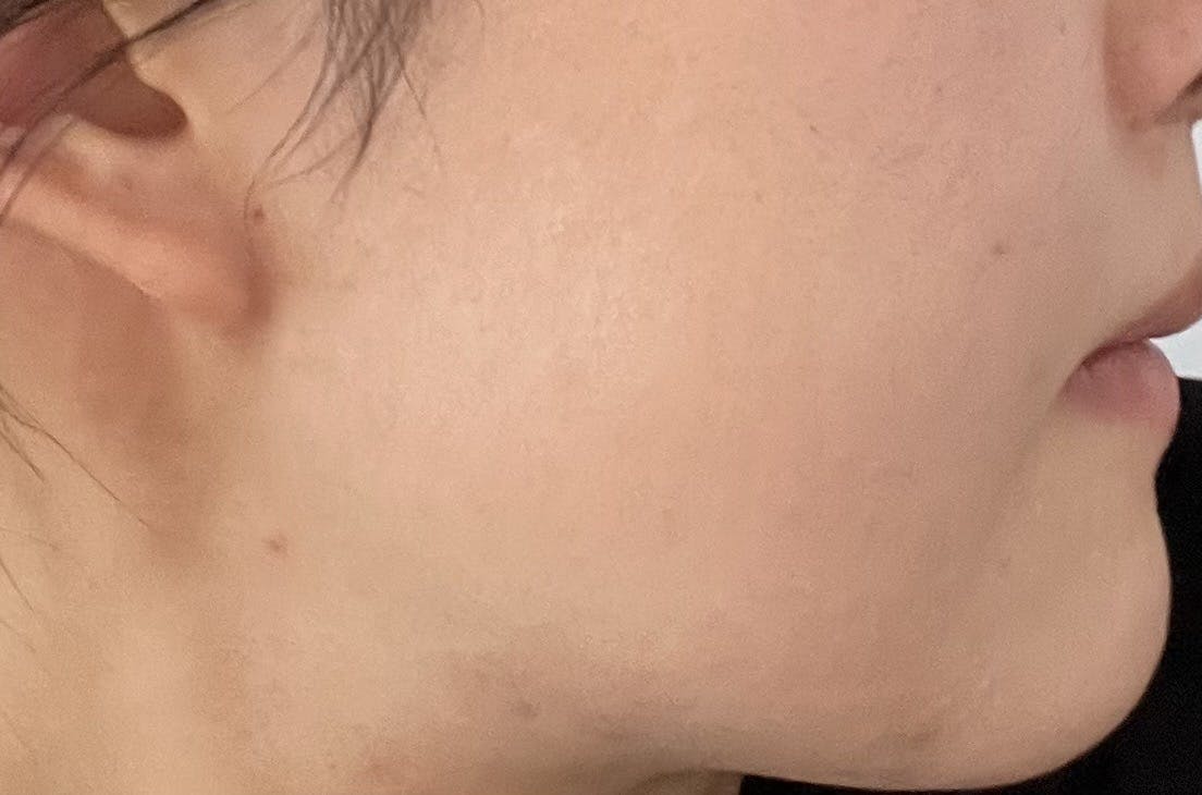 ジュンクリニック(JUN CLINIC)でほくろ取りを受けたSaki9991さんの写真