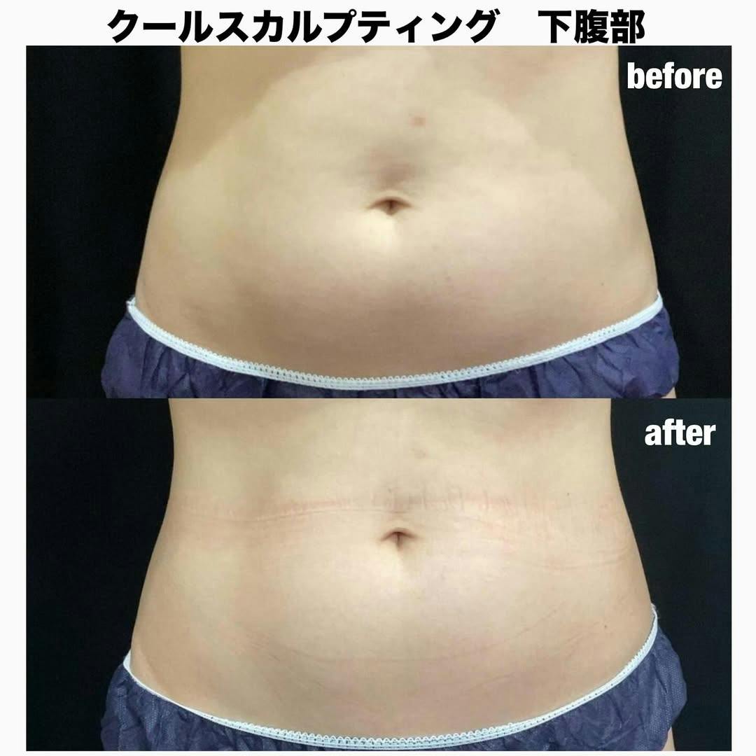 【女性・下腹部】クールスカルプティング_before_aftar