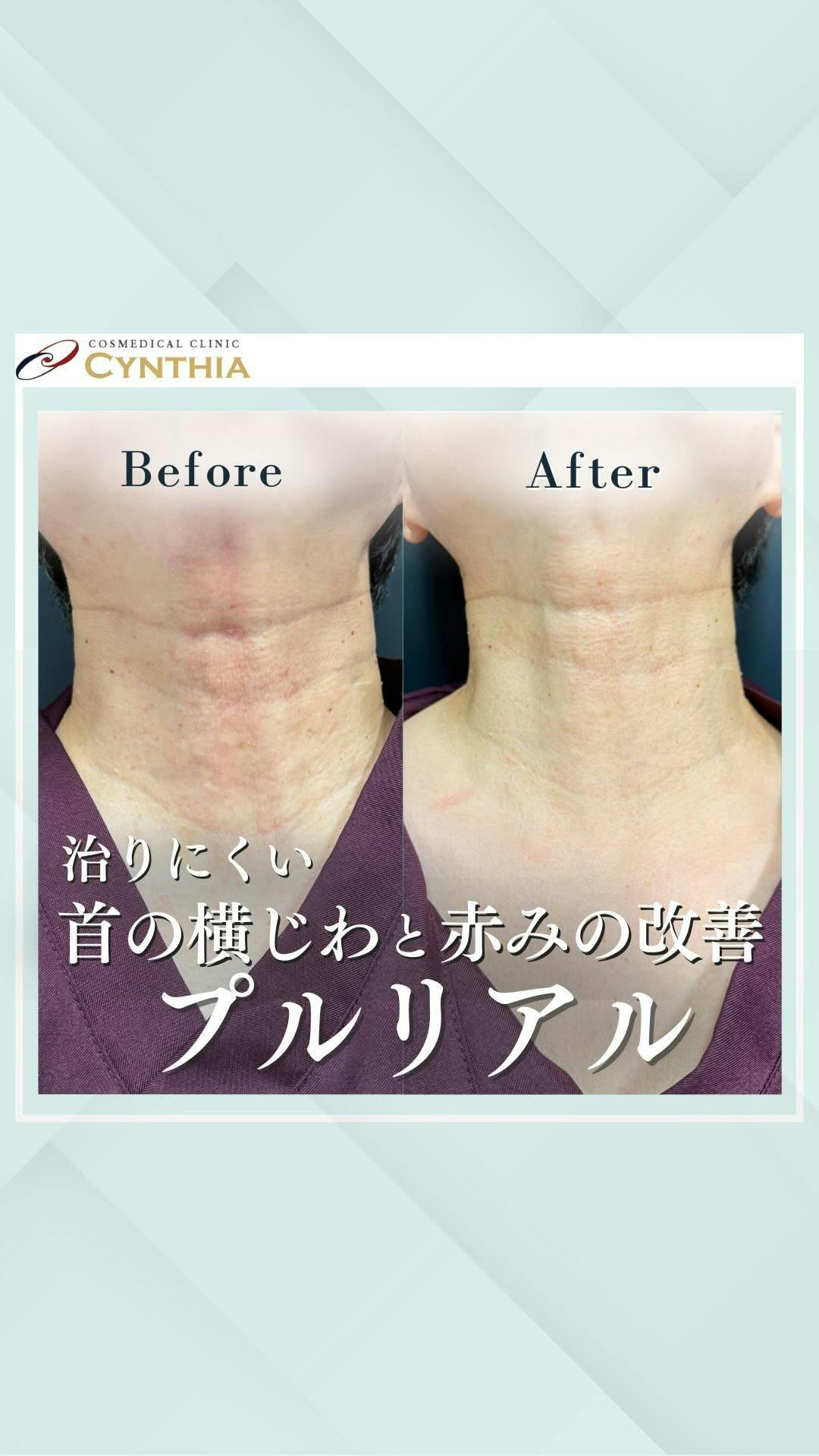 【女性・首】プルリアルデンシファイ_before_aftar
