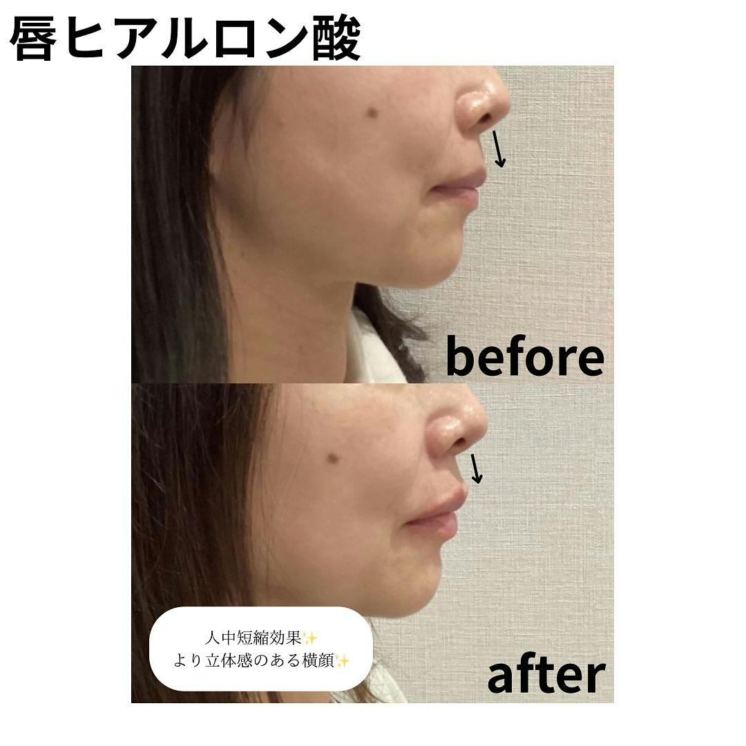 【女性・唇】ヒアルロン酸_before_aftar