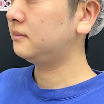 【20代男性・顔】根こそぎVASER脂肪吸引、ジョールファット除去術、あざむくみ抑制ドレナージュ_before