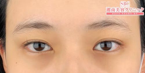 【女性・目元】眉下リフト、目頭切開プレミアム_before