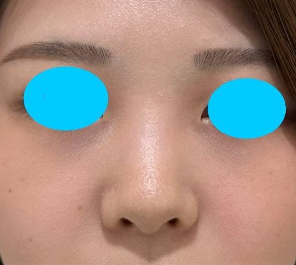 品川美容外科上野院でヒアルロン酸注入：クレヴィエルを受けたゆいぴさんの写真
