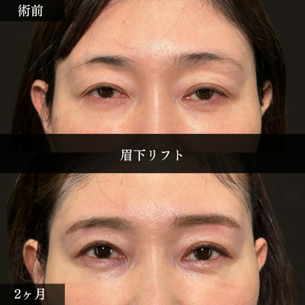 【40代女性・眉下】眉下リフト_before_aftar