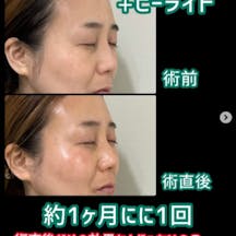 【女性・ツヤ】マッサージピール+ヒーライト_before_aftar