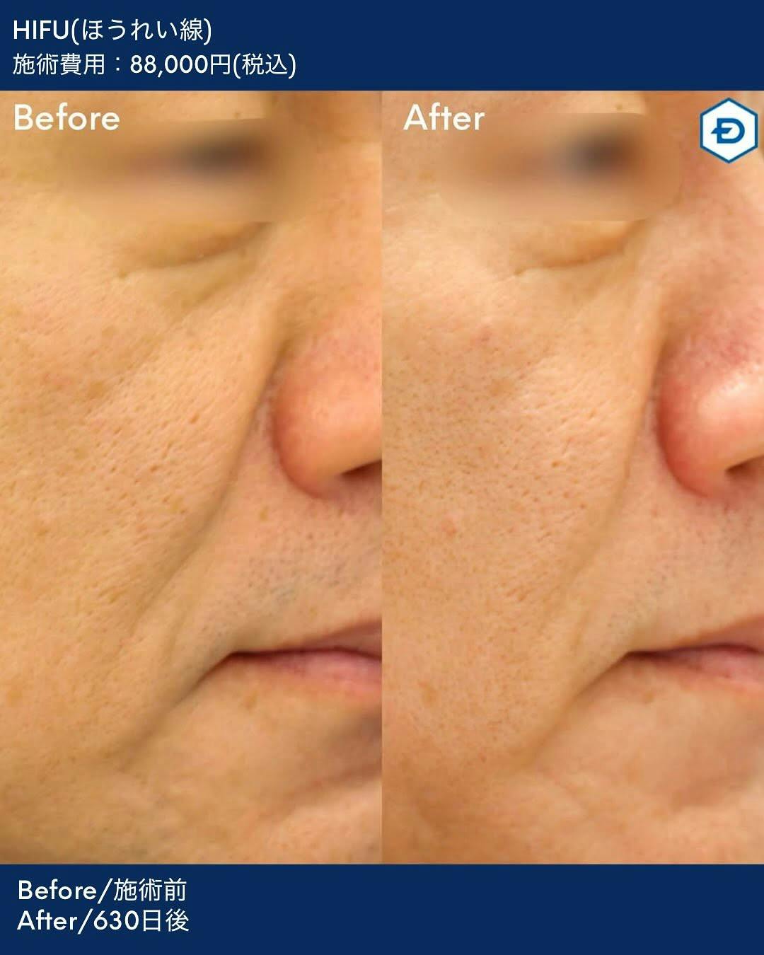 【男性・たるみ】顔のたるみ取り(HIFU UltracelQ+)_before_aftar