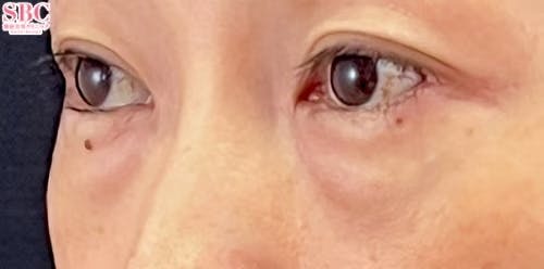 【40代女性・目元】_目の下の切らないクマ・たるみ（ふくらみ）取り、ナチュラル脂肪注射コンデンスリッチ_before