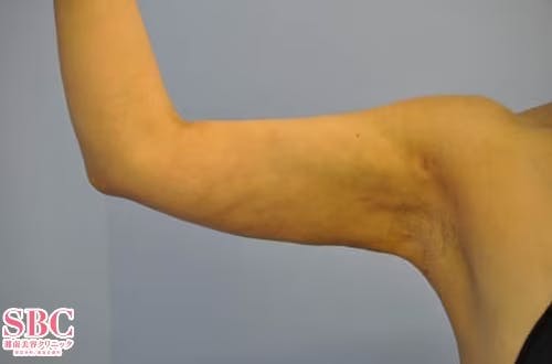 【女性・二の腕】根こそぎVASER脂肪吸引、ライポマティック脂肪吸引、Aquicell（アキーセル）脂肪吸引_aftar