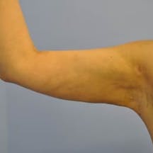 【女性・二の腕】根こそぎVASER脂肪吸引、ライポマティック脂肪吸引、Aquicell(アキーセル)脂肪吸引_aftar