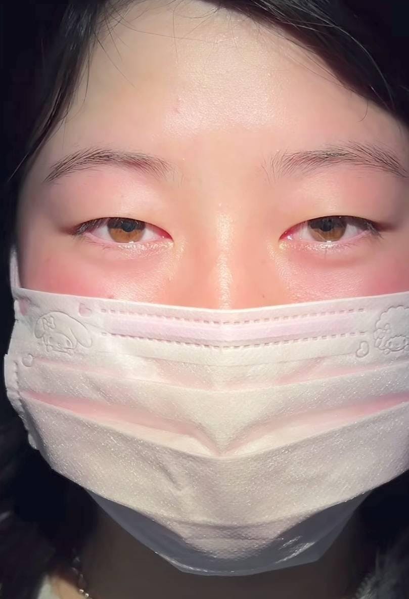 TCB東京中央美容外科 新宿三丁目院で二重埋没法：TCB式1dayクイックアイナチュラルを受けたのんさんの写真