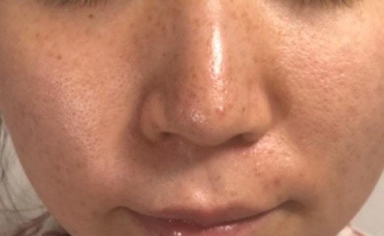 品川スキンクリニック 品川本院でシミ取りレーザー治療：レーザートーニング（メドライトC6）を受けたHONNYさんの写真