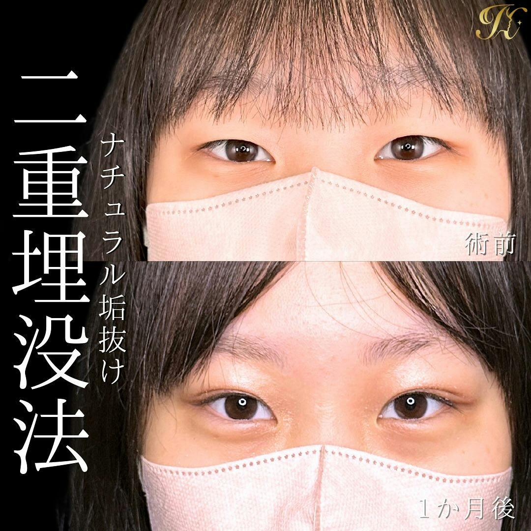 【女性・目元】HBC式二重埋没法_before_aftar