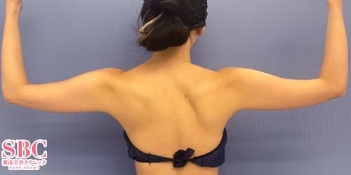 【女性・二の腕】Aquicell（アキーセル）脂肪吸引、根こそぎVASER脂肪吸引_before