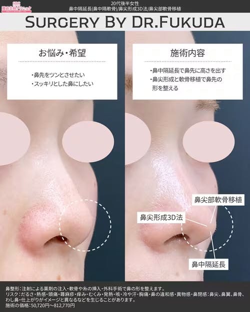 【女性・鼻】鼻中隔延長、鼻尖形成3D法、鼻尖部軟骨移植_before_aftar