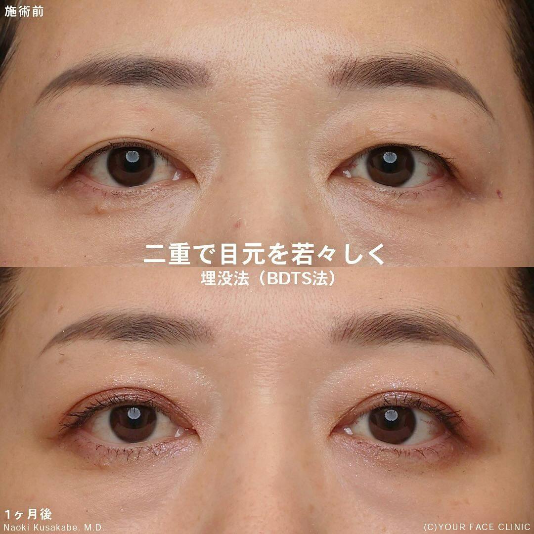 目の下のクマ・たるみ取り・ボトックス注射・リジュラン注射(高濃度サーモン注射)・リジュランアイ・アラガン製ボトックス・クマ取り注射 ・スキンブースター・リジュランHB・目元整形の症例写真・ビフォーアフター画像No.5275 | 湘南美容クリニック 自由が丘院, image size:1080x1080