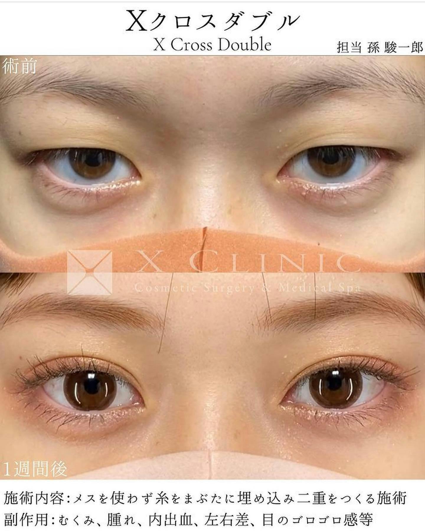 【女性・目元】エックスクロスダブル_before_aftar