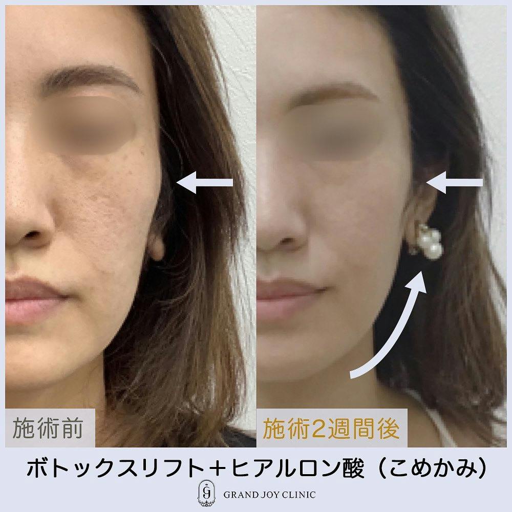【女性・輪郭】ヒアルロン酸・ボトックスリフト_before_aftar