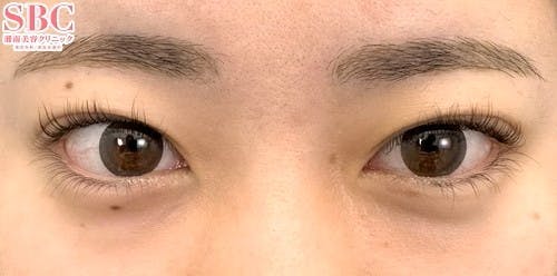 【20代女性・目元】週末二重(R)_before