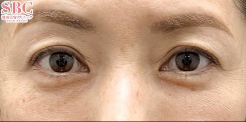 【50代女性・クマ】裏ハムラ法 ナチュラル脂肪注射ナノリッチ_after