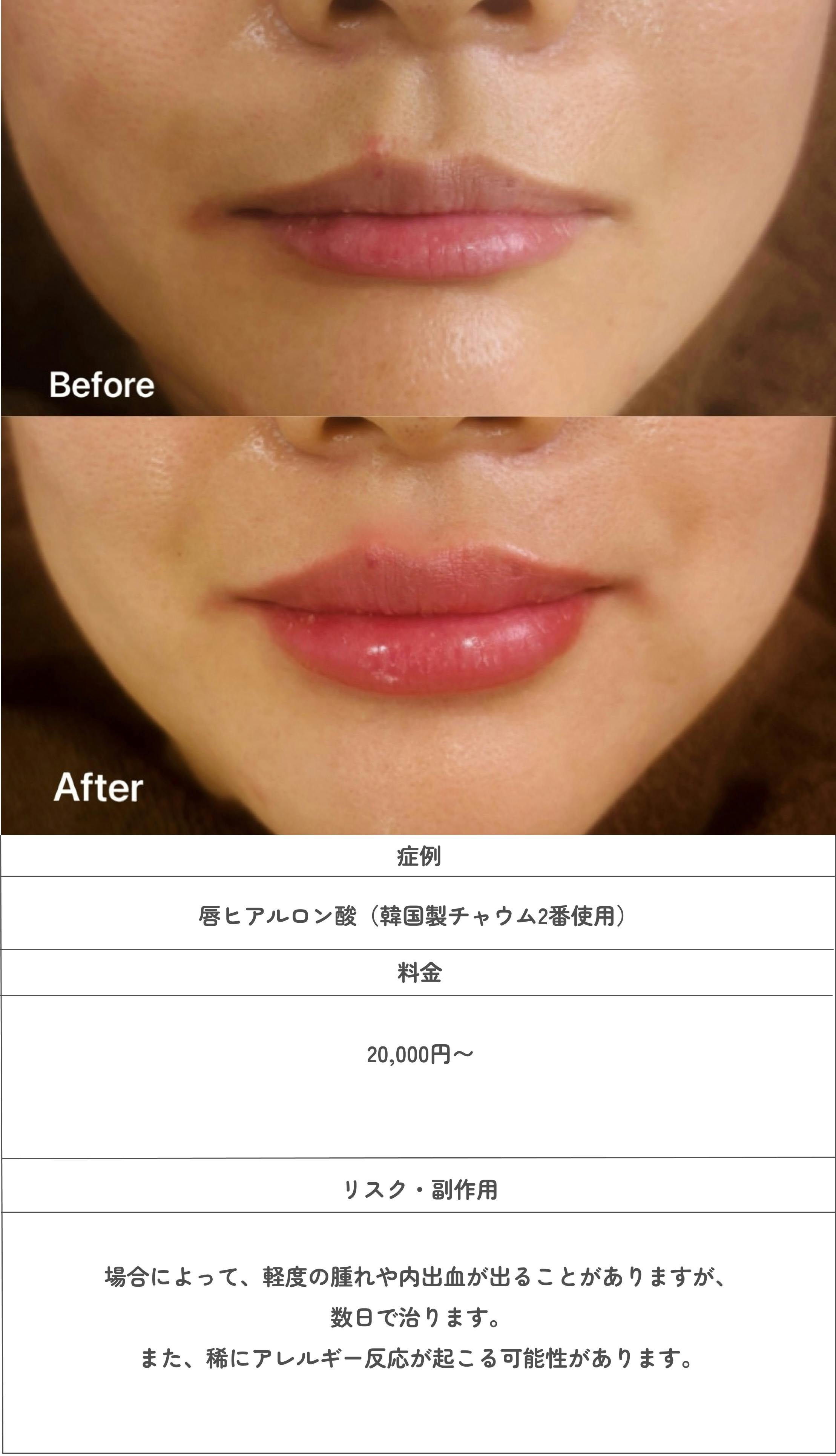 唇ヒアルロン酸の症例写真