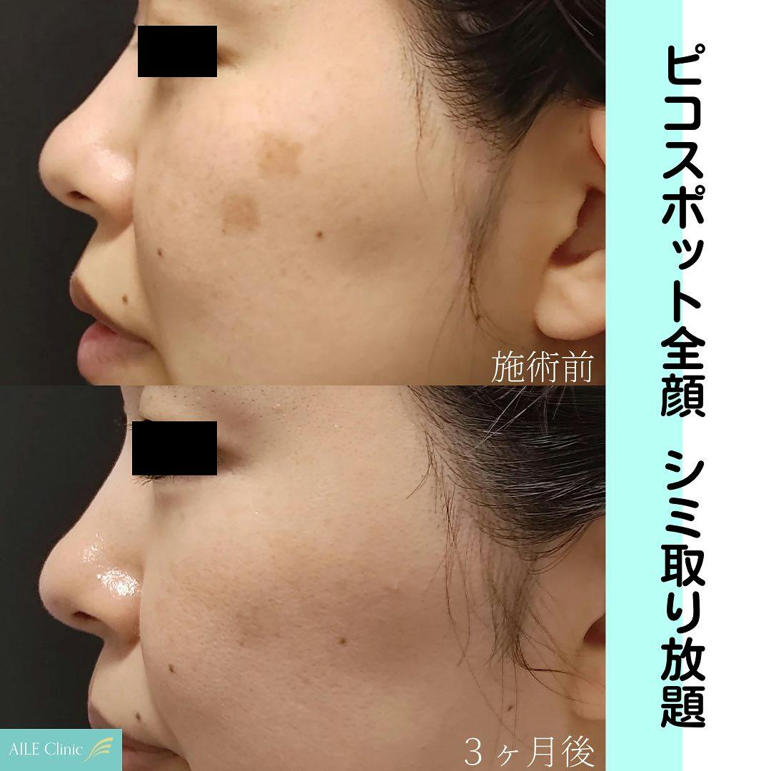 【女性・頬】ピコスポット全顔シミ取り放題_before_aftar
