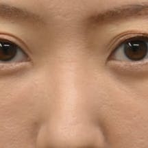 【30代女性・目元】目の下の切らないクマ・たるみ(ふくらみ)取り ナチュラル脂肪注射コンデンスリッチ ナチュラル脂肪注射ナノリッチ_after