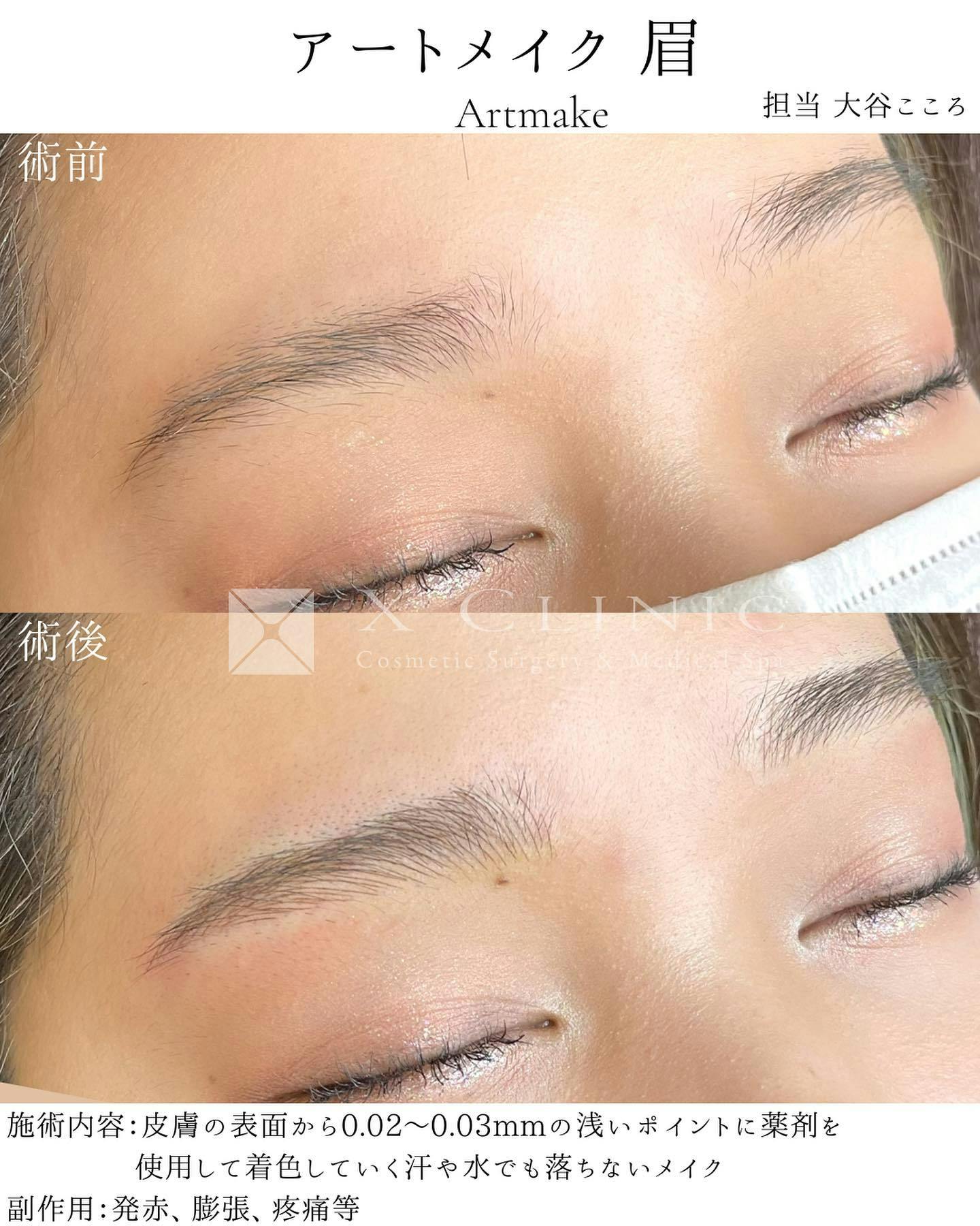 【女性・眉】眉毛アートメイク_before_aftar