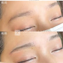 【女性・眉】眉毛アートメイク_before_aftar
