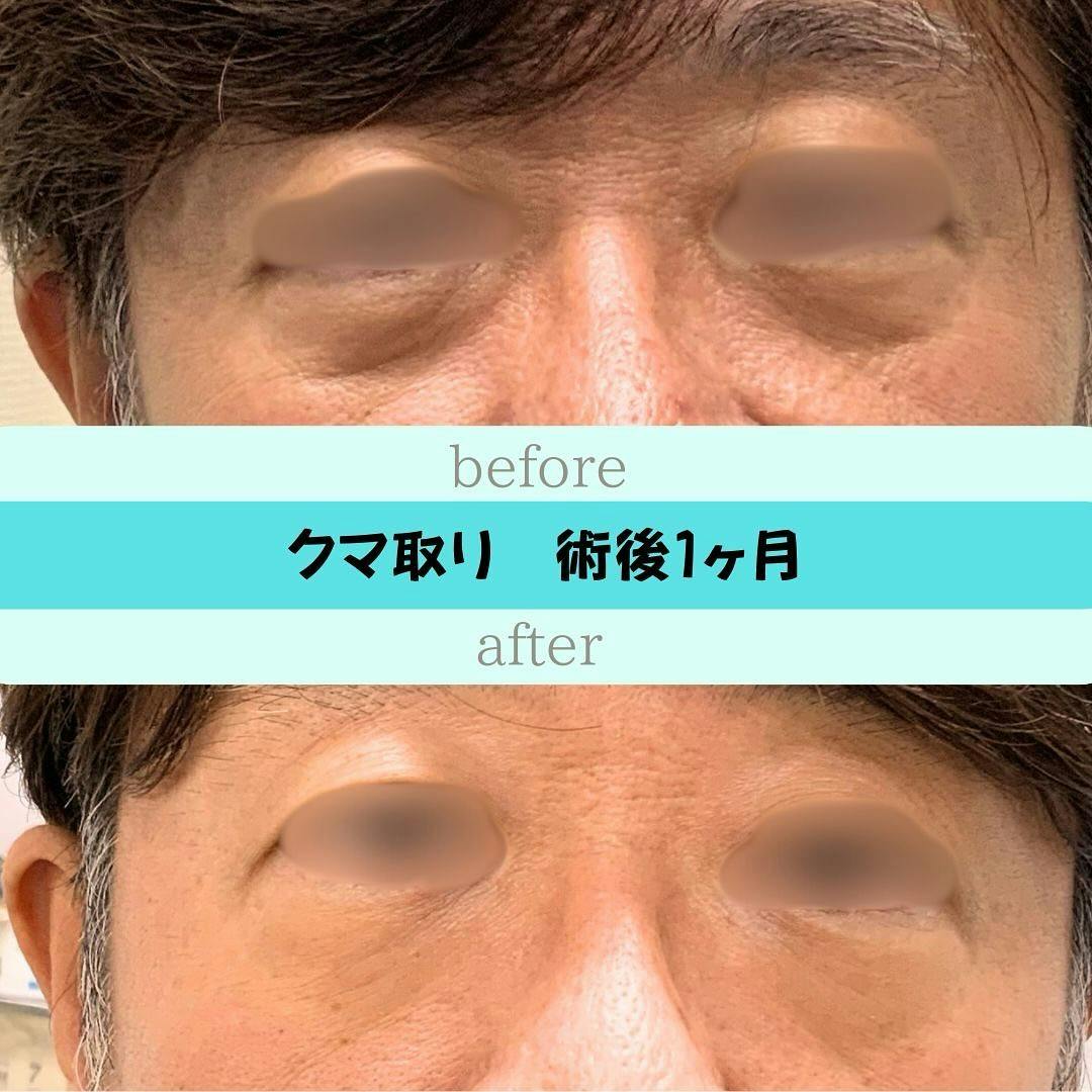 【男性・クマ】クマ取り(経結膜脱脂)_before_aftar