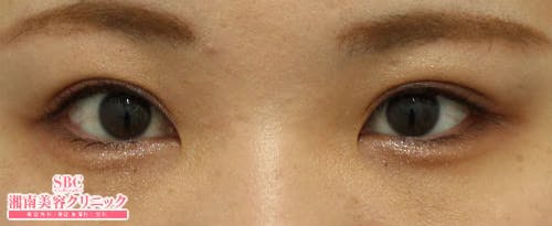 【女性・目元】クイックコスメティーク・ダブルNeo、SBC『デカ目』術、自然癒着セット（上眼瞼脱脂）_before