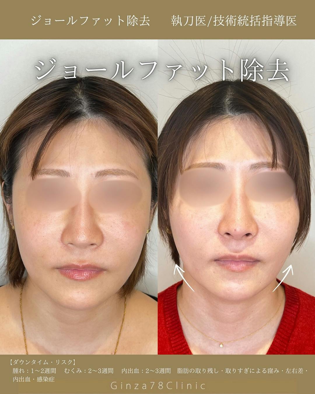 【女性・頬】ジョールファット除去_before_aftar