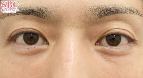 【40代・たるみ】目の下の切らないクマ・たるみ（ふくらみ）取り ナチュラル脂肪注射コンデンスリッチ ナチュラル脂肪注射ナノリッチ_after