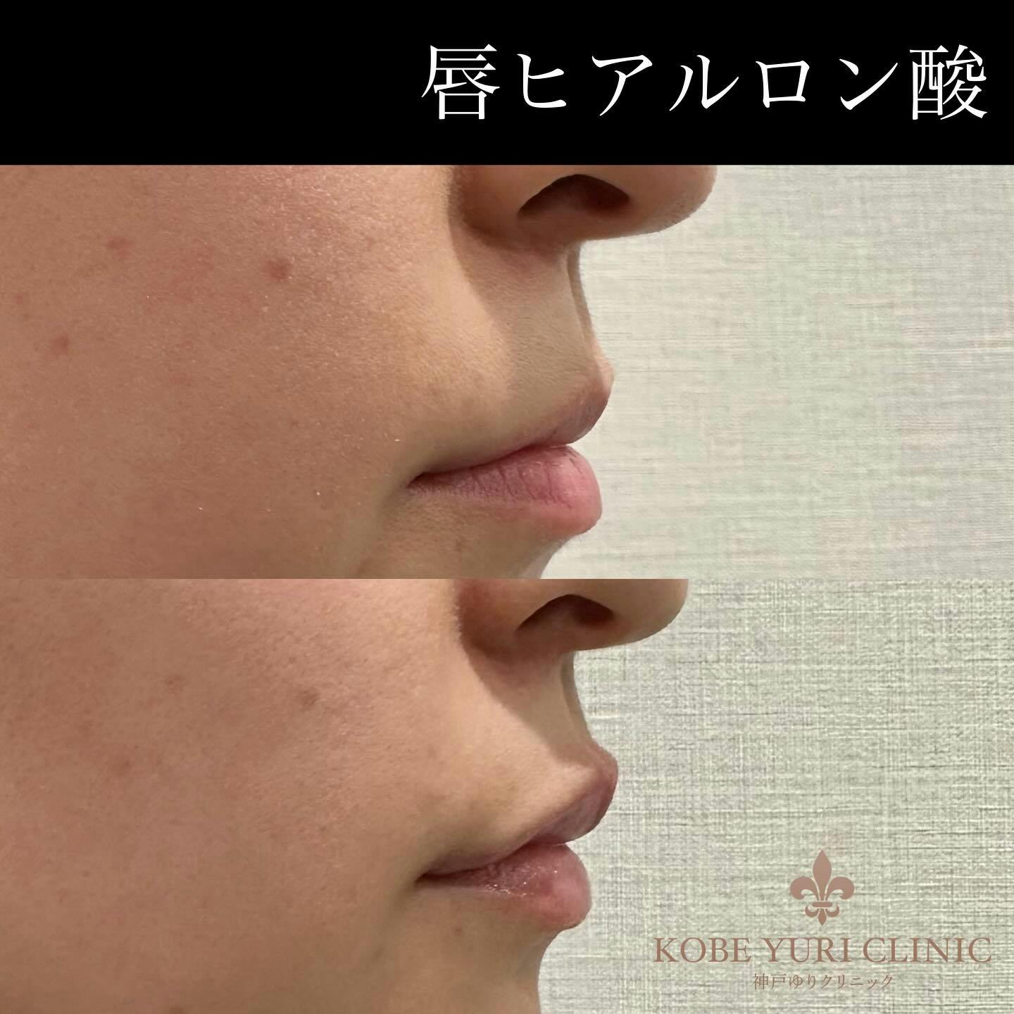 【女性・唇】ヒアルロン酸（唇）_before_aftar
