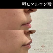 【女性・唇】ヒアルロン酸(唇)_before_aftar