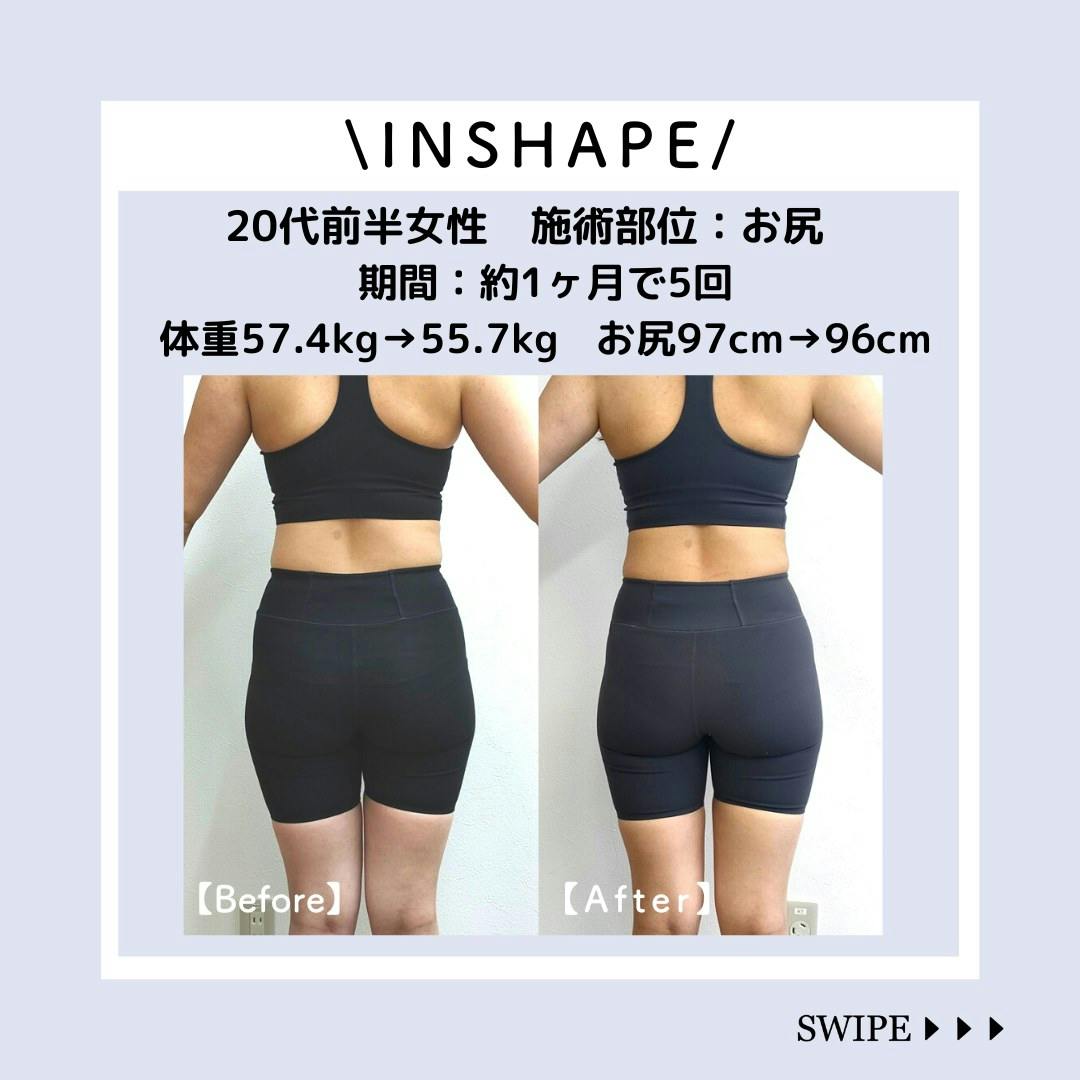 【20代女性・臀部】INSHAPE（インシェイプ）_before_aftar