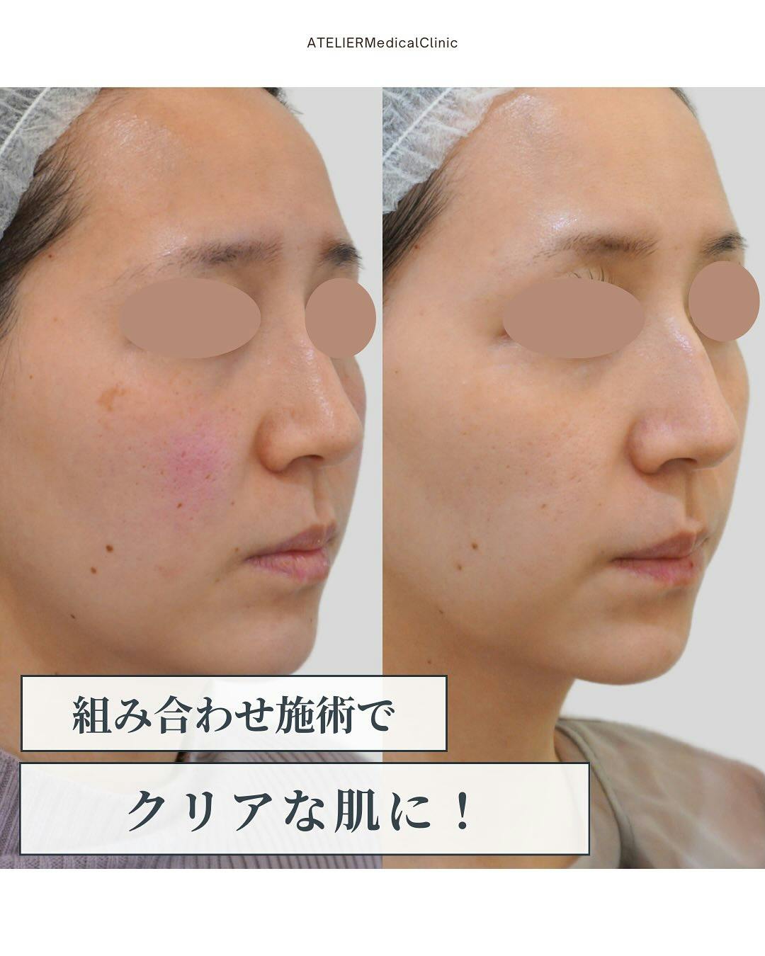 【女性・赤み】ピコスポット ピコトーニング ピーリング ヴァンパイア注射_before_aftar