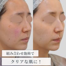 【女性・赤み】ピコスポット ピコトーニング ピーリング ヴァンパイア注射_before_aftar