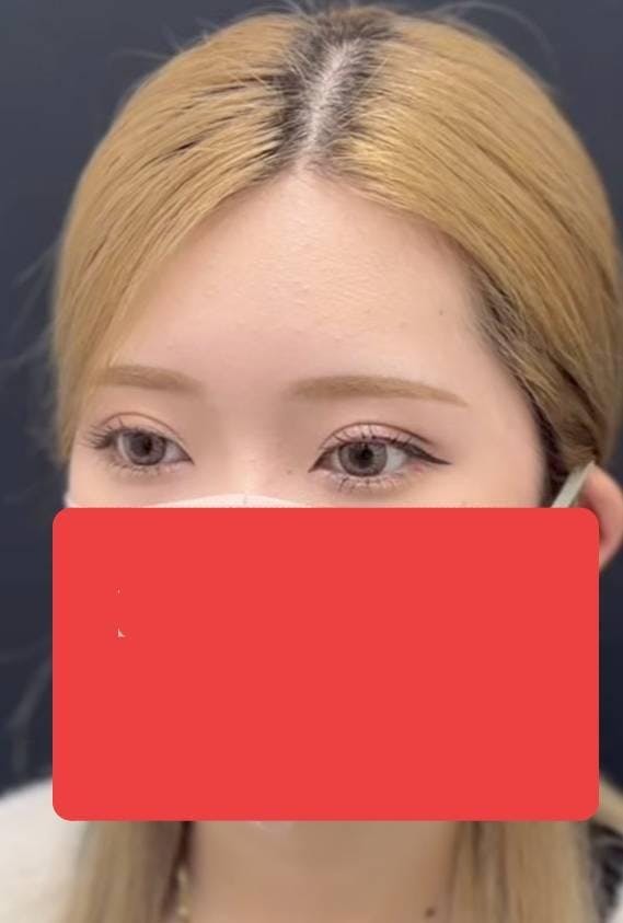 湘南美容クリニック 新宿本院で二重埋没法：クイックコスメティークシングルを受けたみにょんさんの写真