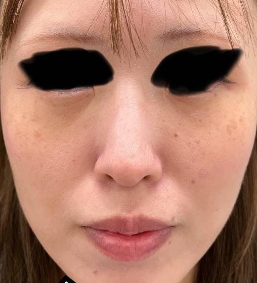 湘南美容クリニック  名古屋院で目の下のクマ取り：クマ取り＋脂肪注入を受けたばななさんの写真
